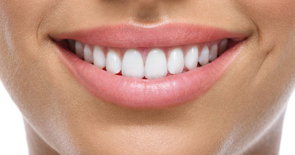 Veneer Tooth Color Chart